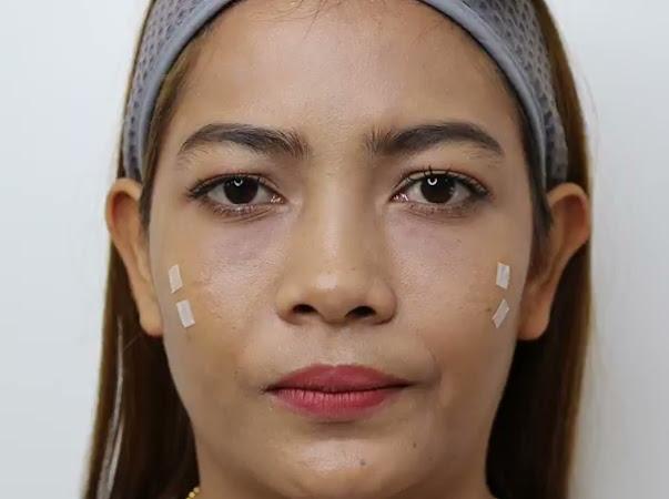 ฉีดฟิลเลอร์ใต้ตา สวยกระชากวัยแบบปลอดภัย